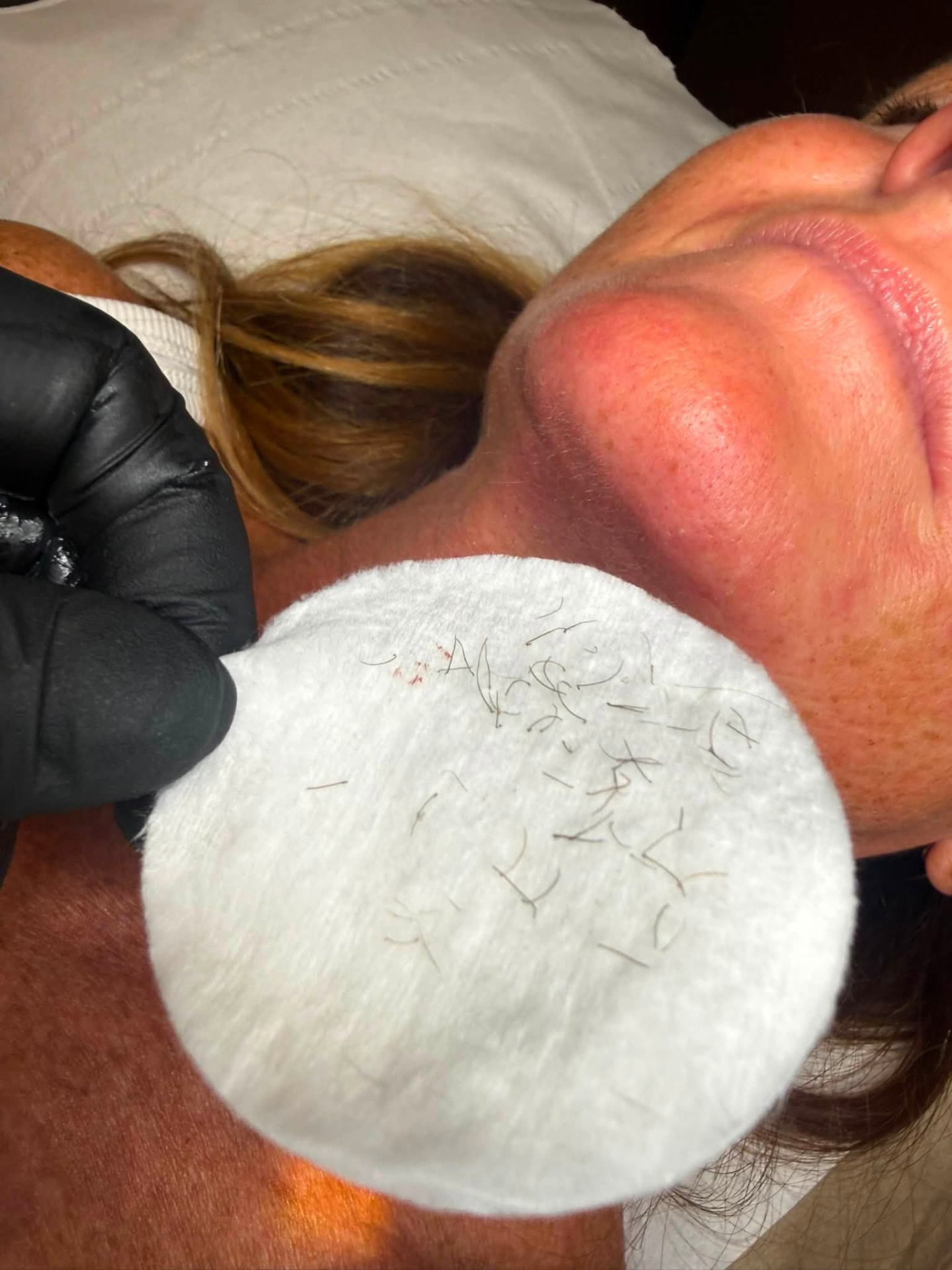 Cotton pad showing hairs cleared in one electrolysis appointment
