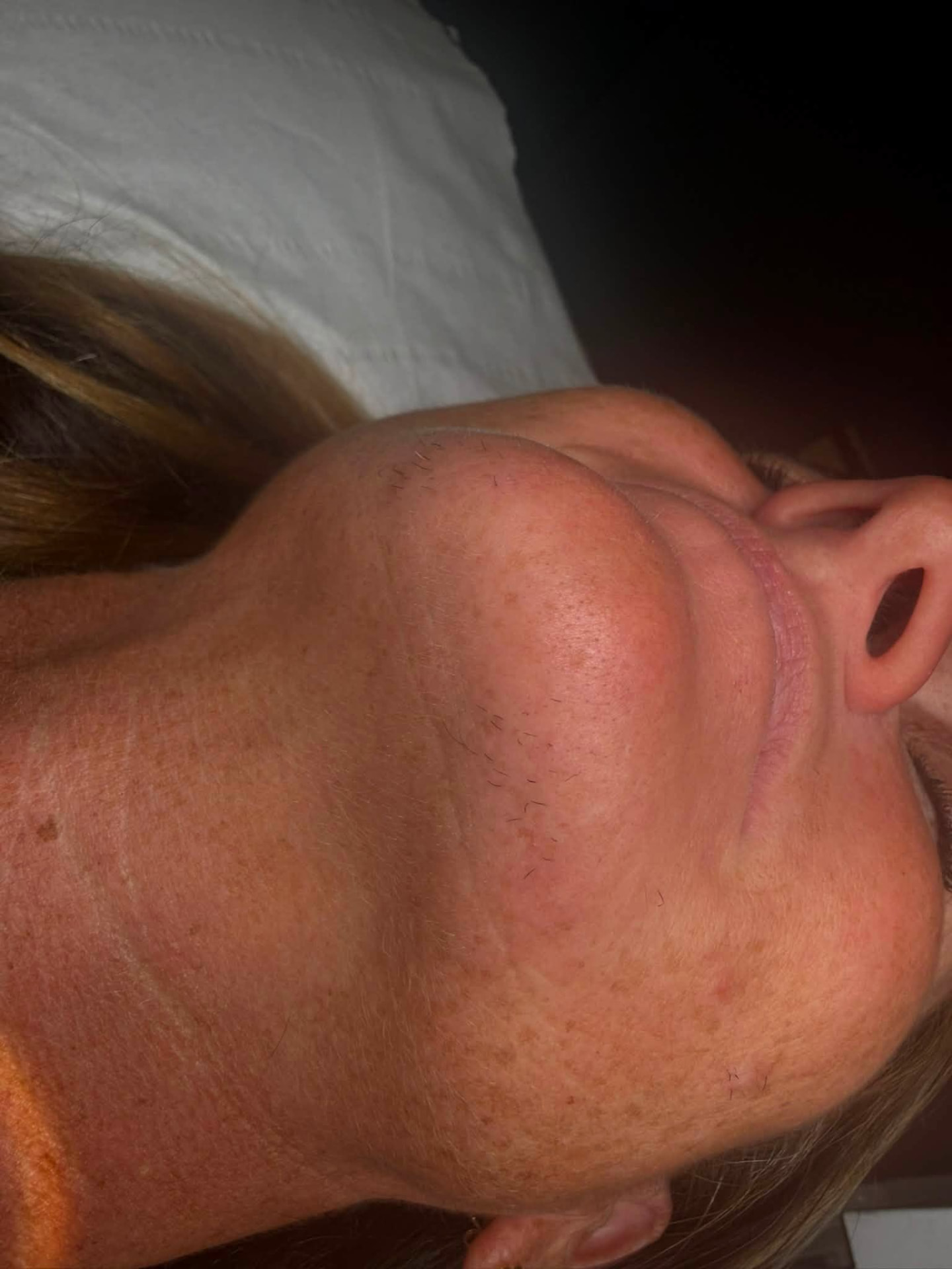 Chin area part way through an electrolysis treatment