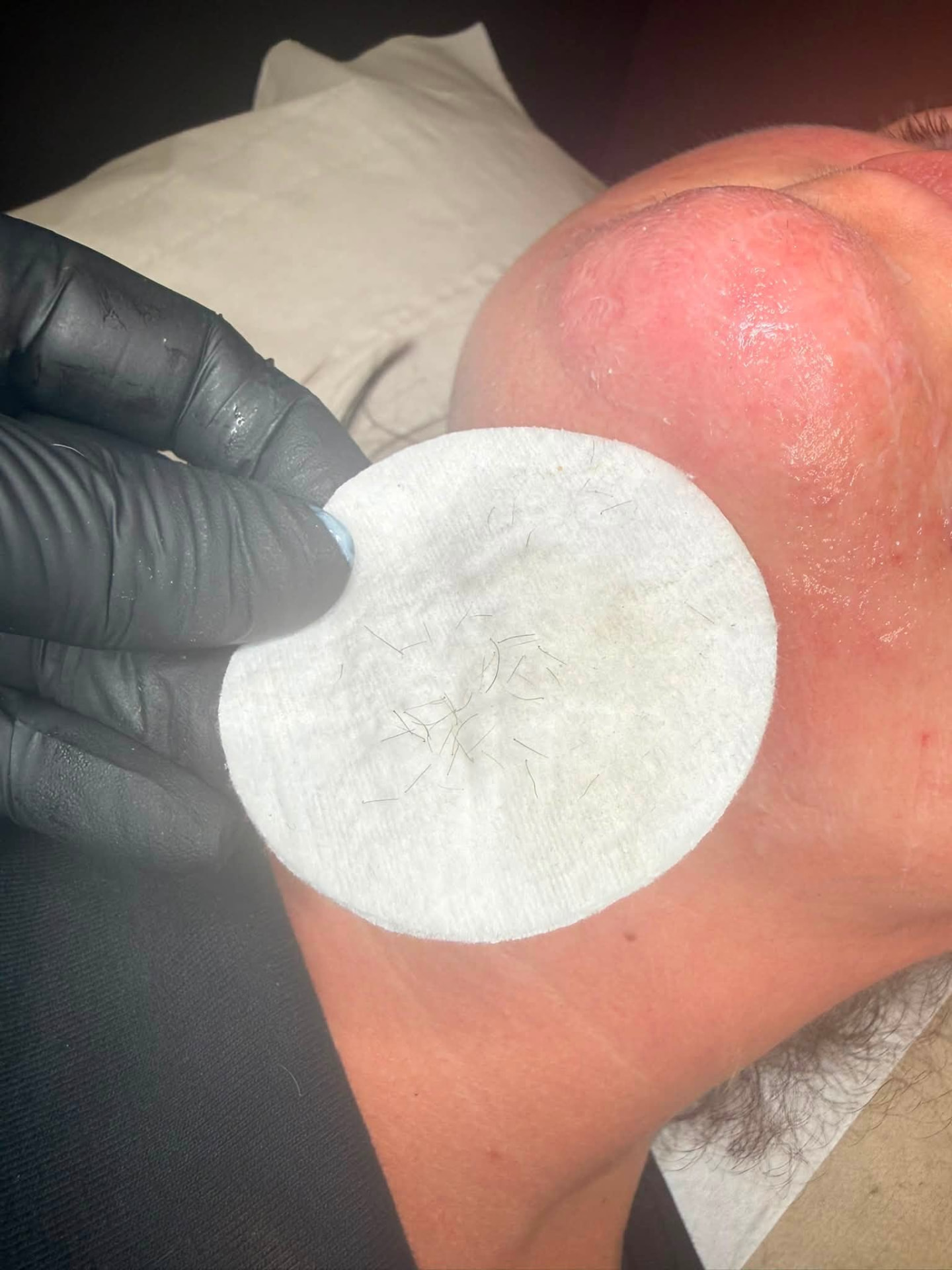 Hairs removed during a chin electrolysis session
