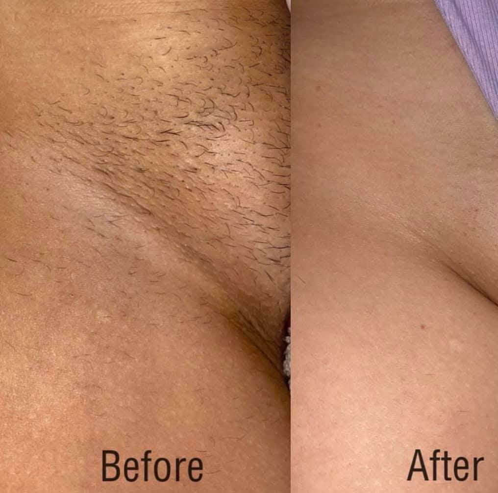 Bikini laser hair removal before and after at Rollo House, Longniddry