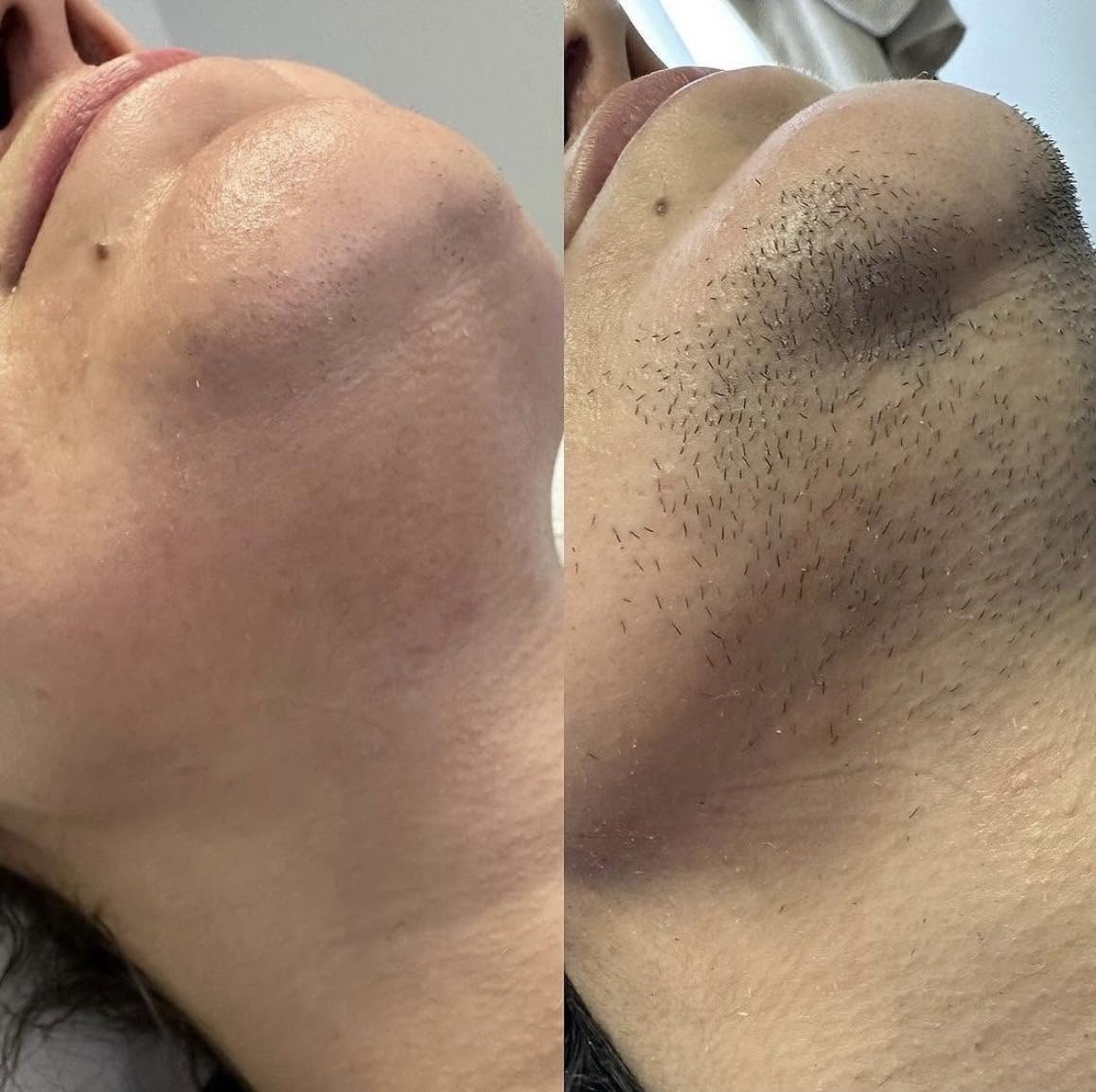 Chin and jaw electrolysis before and after result