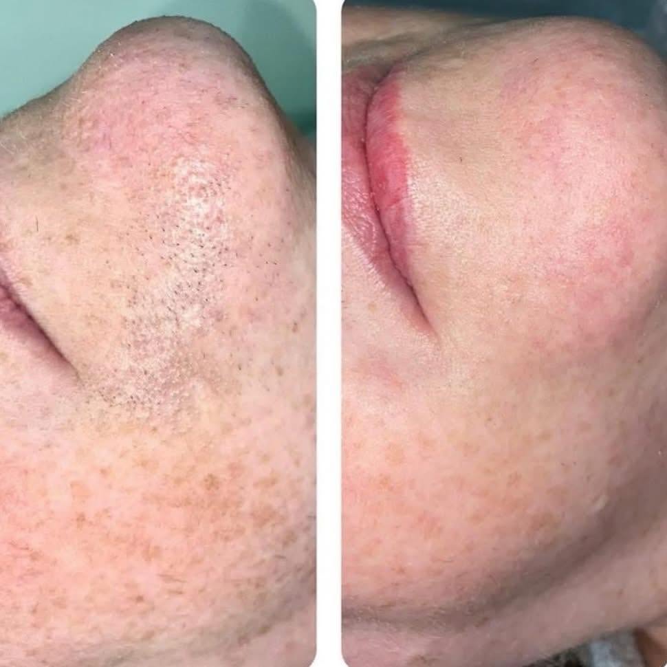 Chin electrolysis before and after result, Longniddry clinic