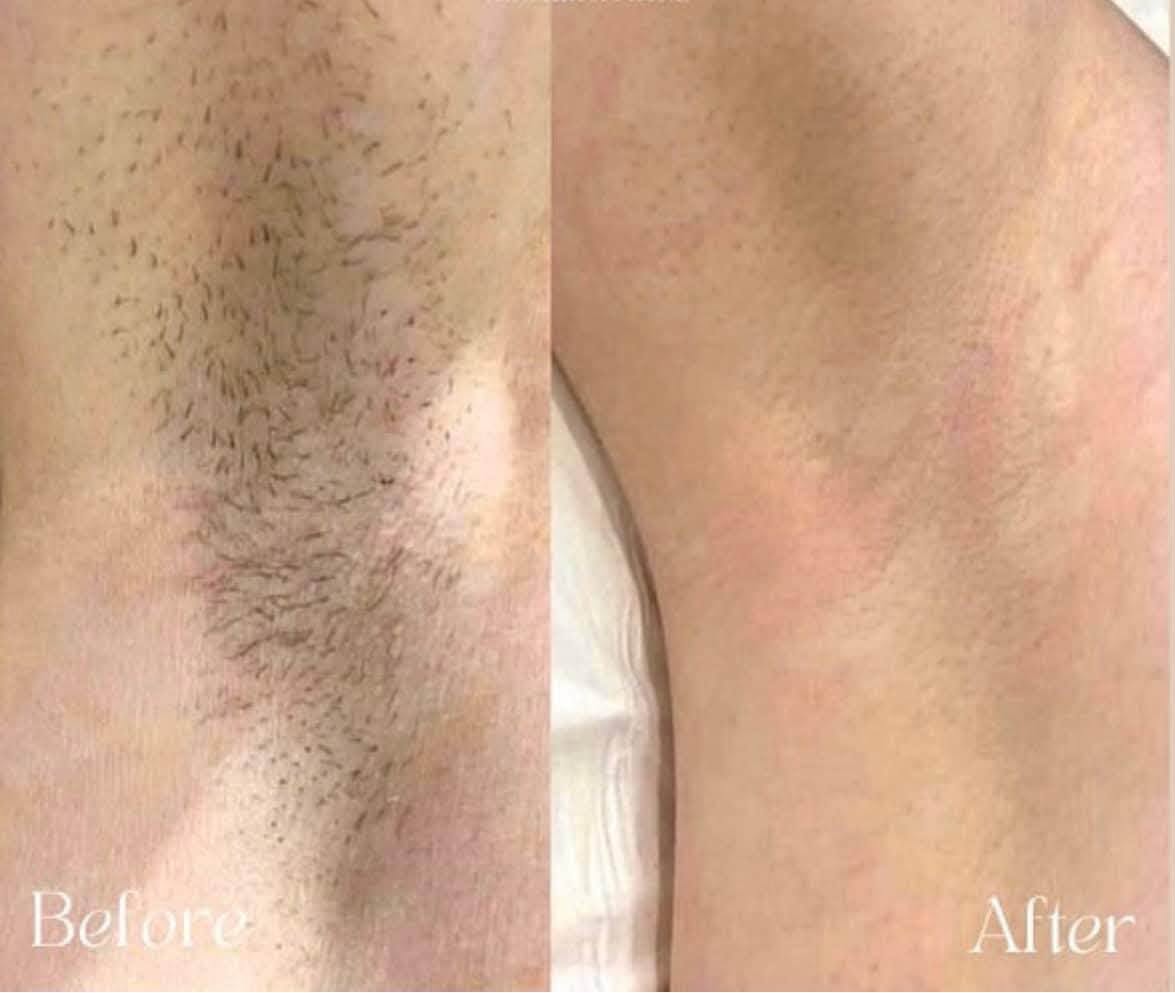 Underarm laser hair removal before and after at Rollo House, Longniddry